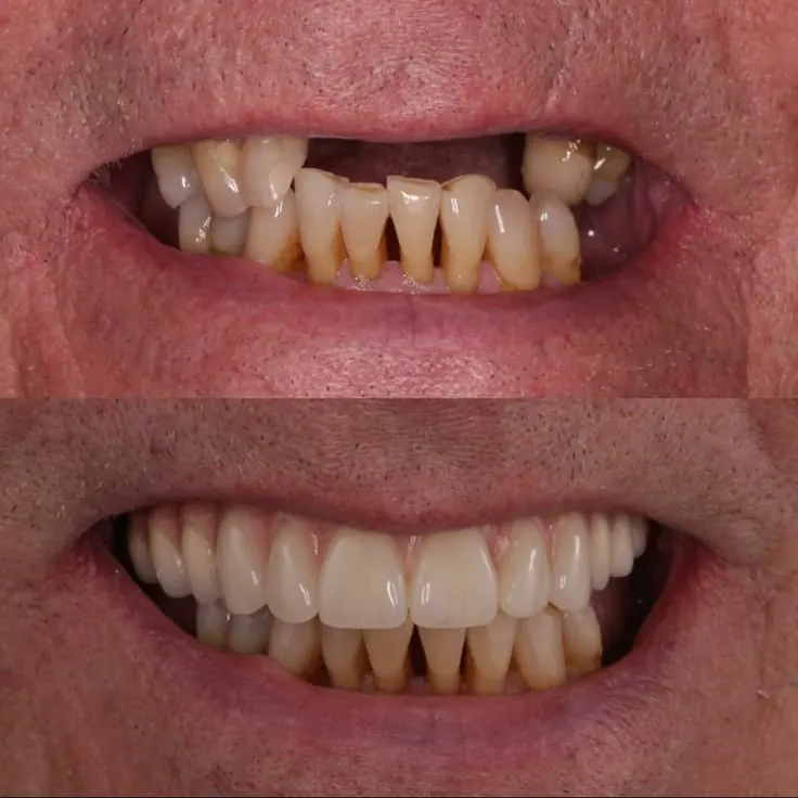 Implantes Múltiplos